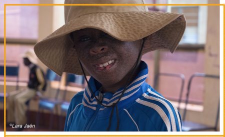 Niño con Xeroderma Pigmentoso Niño con Xeroderma Pigmentoso