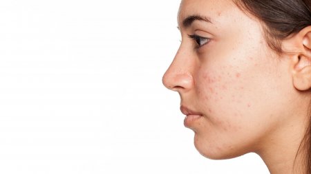 BIODERMA piel mujer hiperpigmentada BIODERMA piel mujer hiperpigmentada