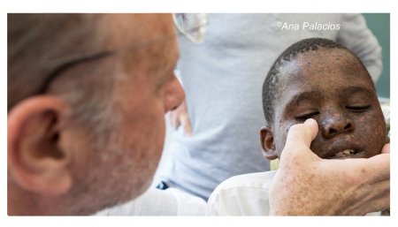 Doctor y niño con Xeroderma Pigmentoso Doctor y niño con Xeroderma Pigmentoso