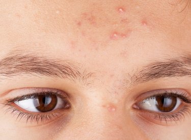 Impacto de la piel con acné en la autoestima